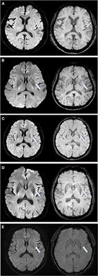 The “Black Straight-Line Sign” in the Putamen in Diffusion-Weighted Imaging: A Potential Diagnostic MRI Marker for Multiple System Atrophy